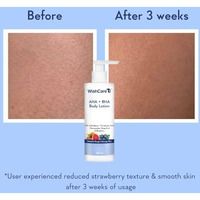 Wishcare 10% Aha + 1% Bha Body Lotion For Men & Women - Body Lotion For Dry Skin - Detans, Smooths Rough & Bumpy Skin 200Ml