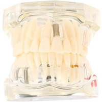 Identical Dental All-In-One Study Model | Includes Dental Implants, Crown & Bridge, Root Canal | Implant-Supported Bridge | Tooth Avulsion | Abfraction, Caries & Periapical Study Feature