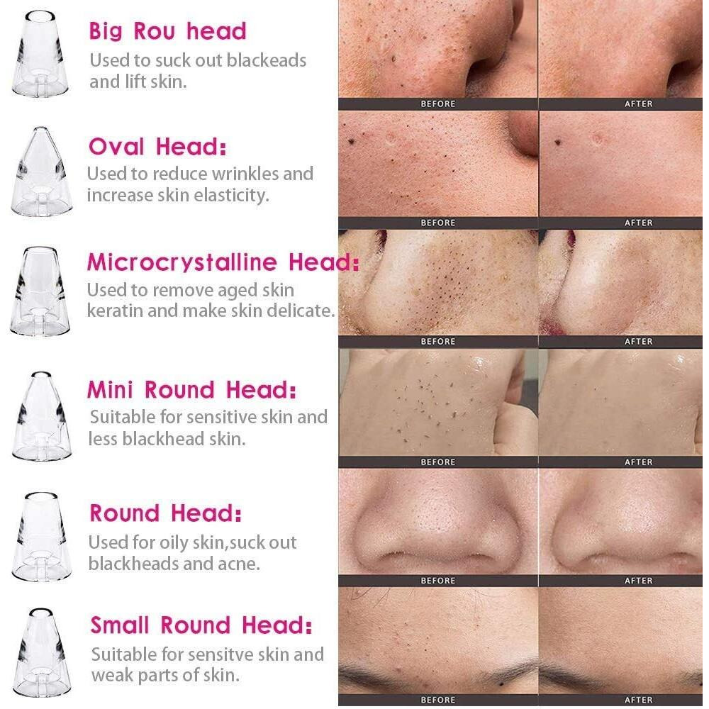 ClothyDeal Premium 6 in 1 Multi-Functional Black & Whitehead Remover With Pimples & Pore Cleaner | 3 Levels Adjustable Mode With 6 Changeable Functional Heads. (Regular)