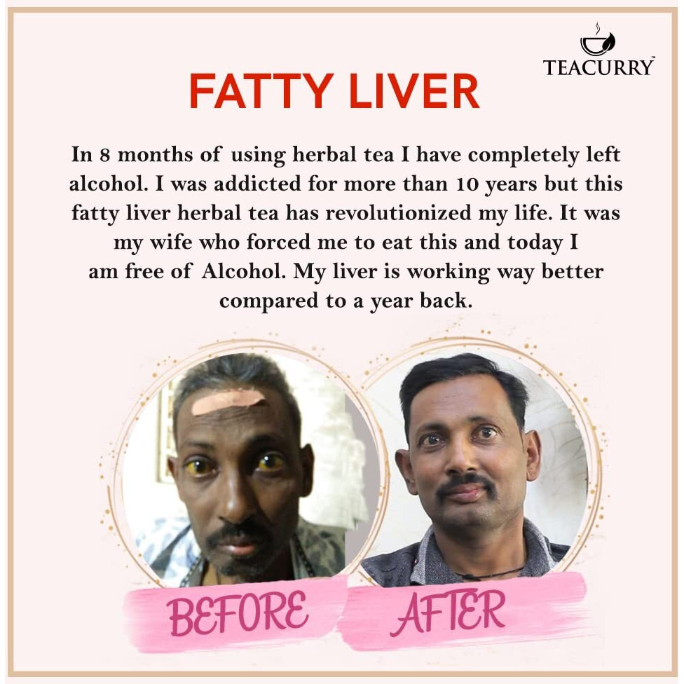 TEACURRY Fatty Liver Tea (3 Month Pack | 90 Tea Bags) - Helps With Abdominal Swelling, Ascites, Enlarged Vessels, 100 grams