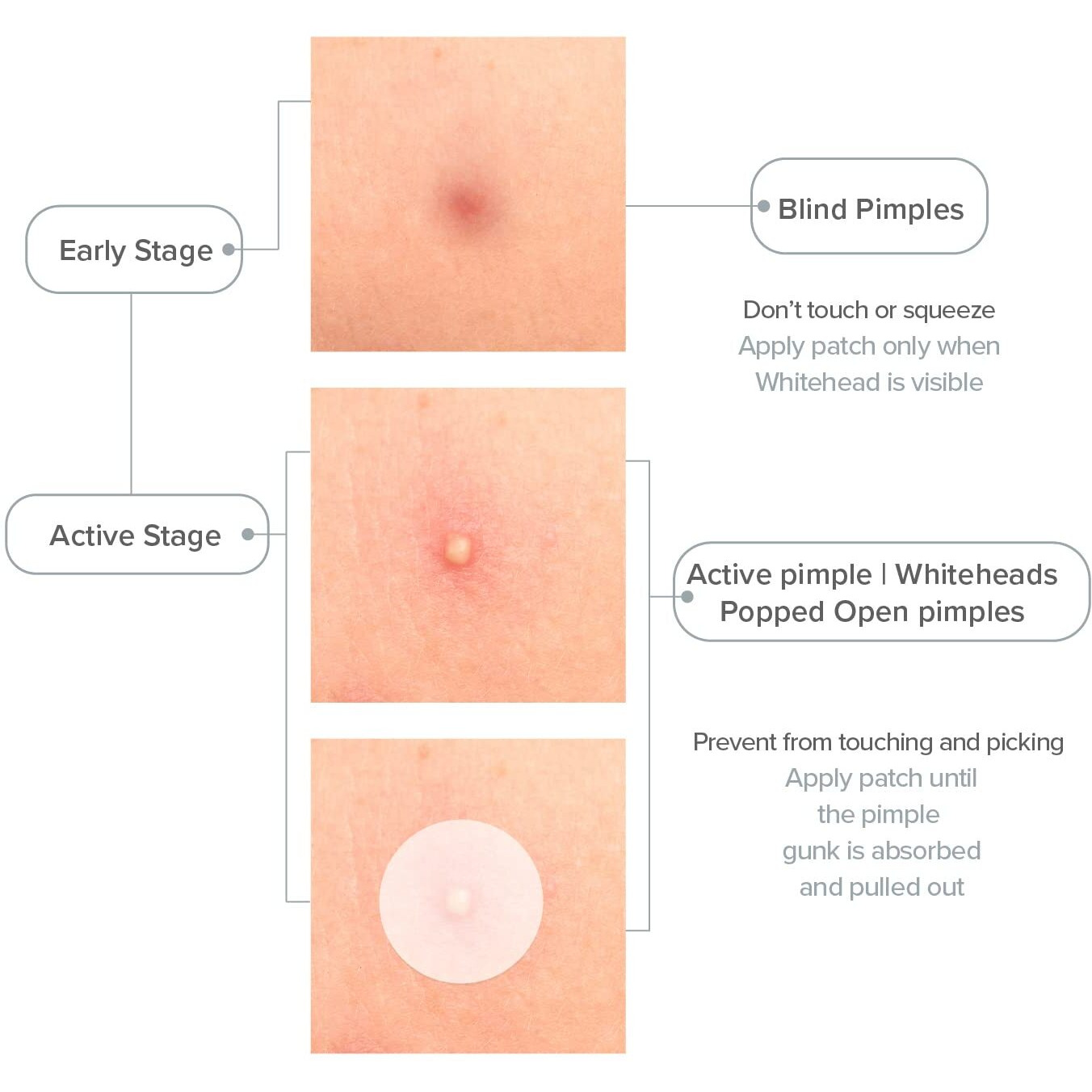 Priveda Acne Pimple Patch 57 Units Hydrocolloid Made In Korea 3 Sizes 8Mm 10Mm 12Mm Waterproof Sheet