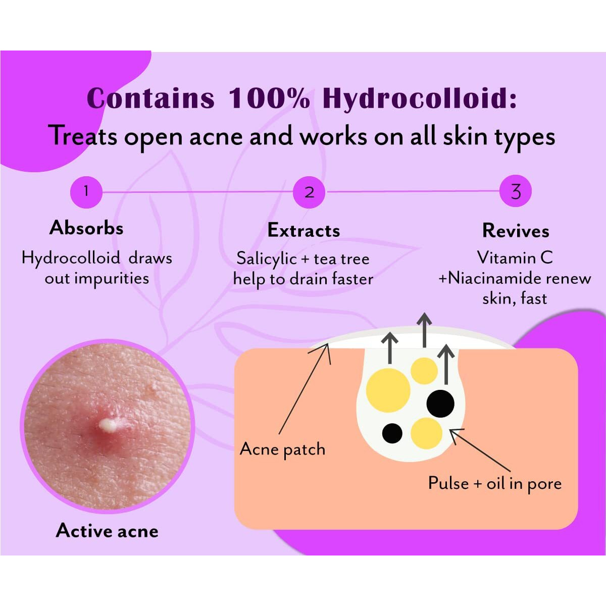 Urban Yog Acne Pimple Patch - Invisible Facial Stickers Cover With 100% Hydrocolloid, Pimple / Acne Absorbing Patch (Curvy Pimple Patch) - Pack Of 1
