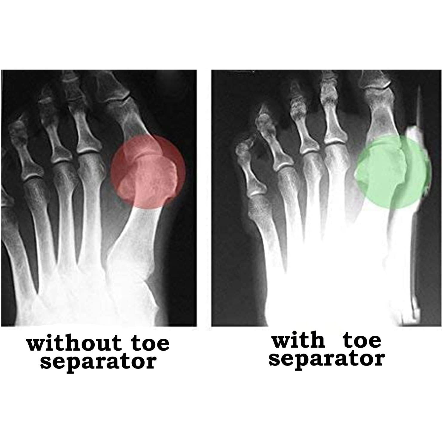 Toe Separator For Feet Toe Spacers Correct Toes Yoga Silicone Hammer Toe Corrector For Women & Men Correct Toe Straighteners For Overlapping Toes (Toe Separator)