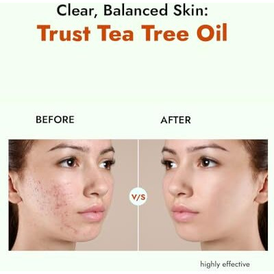 Alziba Cares Tea Tree Face Wash For Acne And Oil Control, Clean And Clear Skin Added With Zinc Pca & D-Panthenol For Smooth And Radiant Skin | Both For Men And Women -100 Ml (Pack Of 1)