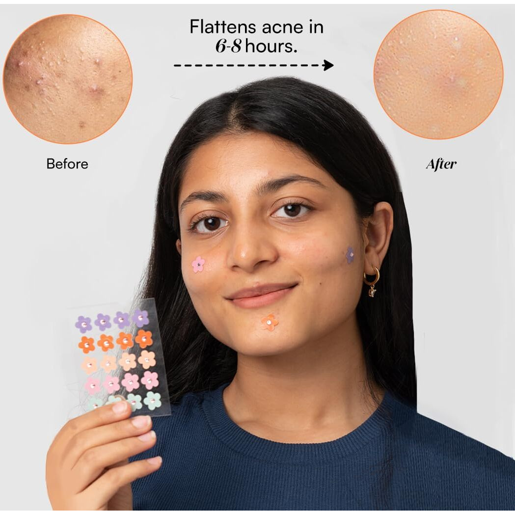 Gush Beauty Acne Pimple Patch | 20 Hydrocolloid Patches With Tea Tree Oil | For Active Surface Acne | Reduces Acne, Pimples & Excess Oil Overnight | (Holographic Butterfly, Pack Of 2)