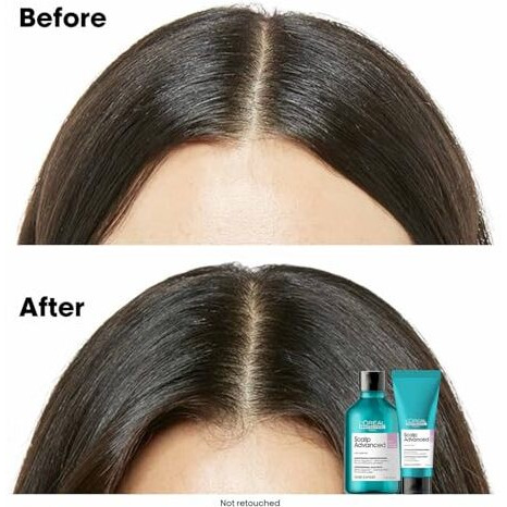 Loreal Professionnel Scalp Advanced Anti-Discomfort Intense Soother Treatment 200Ml | For Sensitive Scalps | Soothe Your Scalp With Niacinamide | For Men & Women