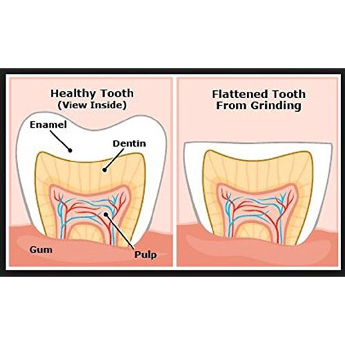 Dentaldoc Teeth Grinding Mouth Guard For Men Prevents Clenching, Tooth Damage And Tmj Pain (Men)