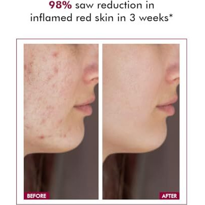 Conscious Chemist 10% Azelaic Acid Cream | 50G | Face Cream For Men & Women, Moisturizer For Acne Prone Skin, Redness Relief, Soothe Irritation & Inflammation, All Skin Types - Azicalm