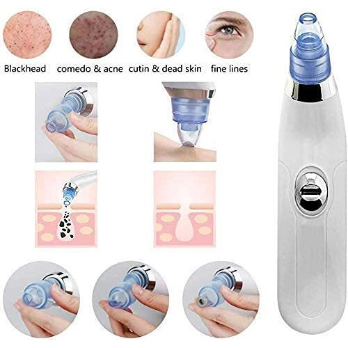 Blackhead Remover, Beautiful Skin Care Expert Acne Pore Cleaner Vacuum Blackhead Remover Kit Skin Cleaner, Pimple Removal Tool, 4 In 1 Multi-Function Blackheads (White-1)