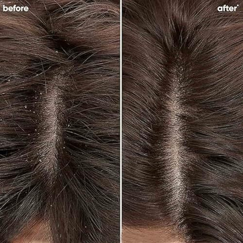 Biolage Professional Scalppure Anti-Dandruff Shampoo, Removes Visible Flakes From 1St Use, Enriched With Bergamot, Shampoo For Men And Women, Deep Scalp Treatment, Vegan & Cruelty-Free, 400Ml