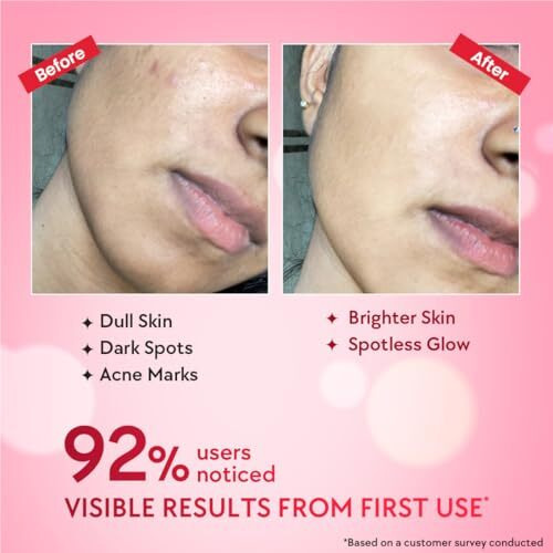 Chicnutrix Outshine  Korean Brightening Face Serum | Made In Korea | 5 Powerful Actives - Niacinamide, Glutathione, Vitamin C | For Pigmentation, Dark Spots & Acne Marks | For All Skin Types
