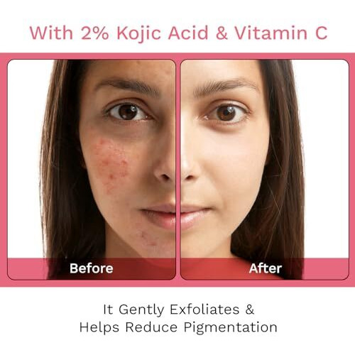 Furr 2% Kojic Acid Soap With Glutathione & Alpha-Arbutin | Cherry Blossom Extract | Reduces Pigmentation | Gently Exfoliates | Unisex | Suitable For All Skin Types | 75G (Pack Of 2)