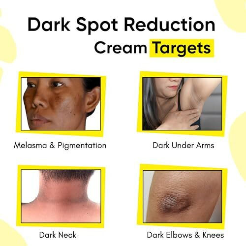 Masofta Dark Spot Reduction & Removal Cream For Melasma, Pigmentation, Acne Marks, Blemishes, Underarms, Neck, Knees & Knuckles | Dark Spot & Patch Corrector | With Kojic Acid, Alpha Arbutin & Niacinamide | For Men & Women | 50G