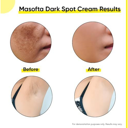 Masofta Dark Spot Reduction & Removal Cream For Melasma, Pigmentation, Acne Marks, Blemishes, Underarms, Neck, Knees & Knuckles | Dark Spot & Patch Corrector | With Kojic Acid, Alpha Arbutin & Niacinamide | For Men & Women | 50G