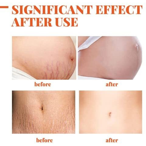 Intimify Stretch Mark Removal Cream For Women, Stretch Mark Cream For Pregnancy, Stretch Mark Cream During Pregnancy, Stretch Mark Removal Ceam After Pregnancy 50G (Pack Of 1)