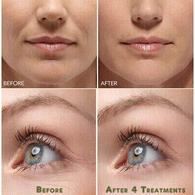 Hyaluronic Acid Powder Lowest Molecular Size Below10 Kda Hyaluronic Better Penetration In Skin Layers 20Gm Hyaluronic Powder