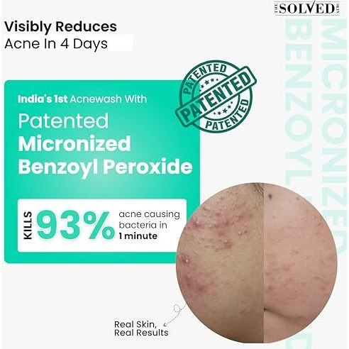 The Solved Skin India's 1St Dermatologically Tested Acnewash With Patented Micronized Benzoyl Peroxide. Kills 99% Acne Causing Bacteria, & Calms Inflamed Pimples In 4 Days. Normal To Oily Skin. 100Ml