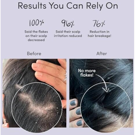 Ravel Anti-Dandruff Shampoo, Fights Flakes & Soothes Scalp Irritation, Reduces Itchiness & Prevents Dandruff, For All Hair Types, Men & Women - 200Ml