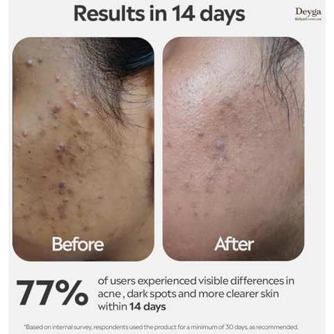 Deyga Charcoal Soap | Reduces Acne, Scars, And Blackheads | Deeply Cleanses And Detoxifies | Perfect For Oily Skin