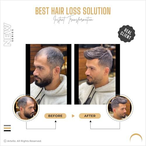 Artello Monofilament Smart Hair Patch For Men, Soft Hair Wig In 100% Natural Human Hair, Easy Fit With Tape, Glue Or Clips, 1D Mono Base (Colour Indian Black) (8X6)