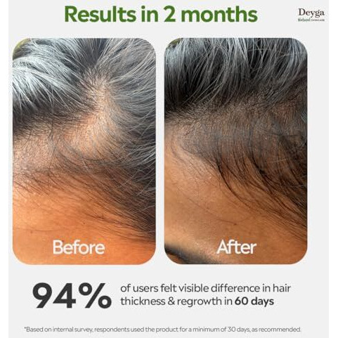 Deyga Hair Growth Oil | Promotes Hair Growth | Reduces Hairfall | Repairs Damaged Hair | Makes Hair Soft & Smooth | Infused With Hibiscus, Rosemary & Grapeseed Oil (100 Ml, Hair Growth Oil) | Suits Men And Women