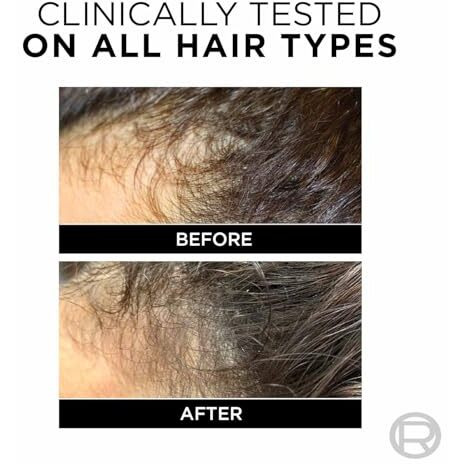 L'Oreal Paris Anti-Hair Fall Shampoo, Reinforcing & Nourishing For Hair Growth, For Thinning & Hair Loss, With Arginine Essence And Salicylic Acid, Fall Resist 3X, 180 Ml