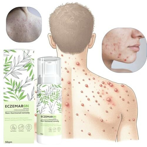 Eczemaron Ringworm Wart, Massa And Skin Tags Removal Herbal And Itchcoat Anti Fungal Ayurvedic Medicine- 50Gm