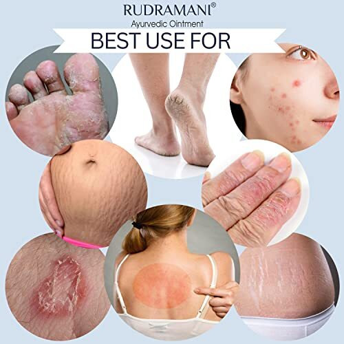 Rudramani Anti Fungal Cream 25G For Men & Women Ayurvedic Itchcoat Anti Fungal Malam For Ringworm Itching Eczema Cream (Pack Of 1)