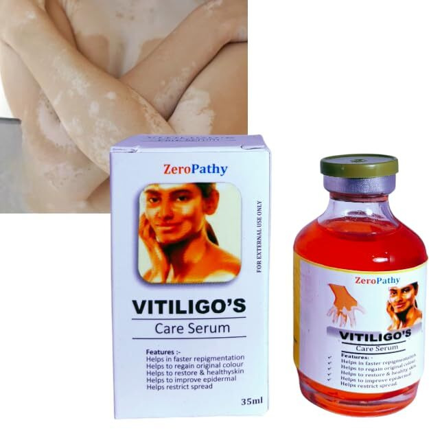 Vitiligo Cream To Care Ringworm White Spots, Tag Skin,Herbal Vitiligo Repair Gel With Organic Aloe Vera And Neem, Helps Fade Patches, Restores Natural Pigmentation Vitiligo Spot For Men & Women. 35Ml