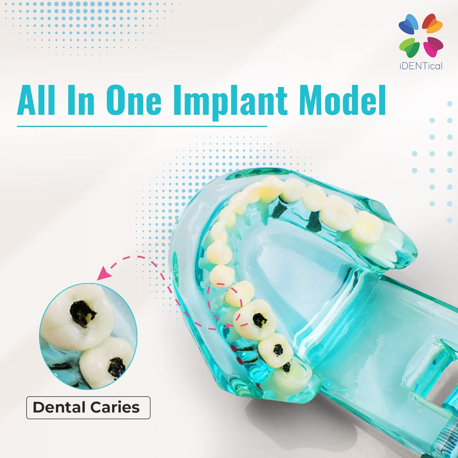 Identical All-In-One Implant & Restoration Model M2001  Blue | Comprehensive Dental Training Model For Implantology, Prosthetics & Restoration | Ideal For Study, Demonstration & Practice