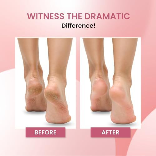 Urban Yog Callus Remover With 3 Interchangeable Head Rollers, Rechargeable, Callus & Dead Skin Removal, 2 Speed Settings, Fast Type-C Charging, 1200Mah Battery
