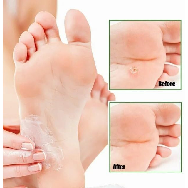 Krifa Enterprises 10 Pcs Foot Corn Removers Plaster Pads - Wart & Callus Remover, Soft Toe Protector With Strong Adhesive