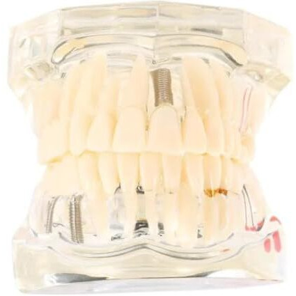 Identical Dental All-In-One Study Model | Includes Dental Implants, Crown & Bridge, Root Canal | Implant-Supported Bridge | Tooth Avulsion | Abfraction, Caries & Periapical Study Feature