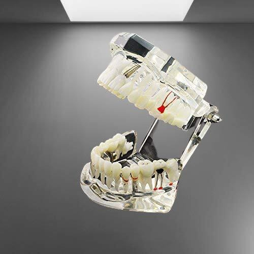 Identical Dental All-In-One Study Model | Includes Dental Implants, Crown & Bridge, Root Canal | Implant-Supported Bridge | Tooth Avulsion | Abfraction, Caries & Periapical Study Feature