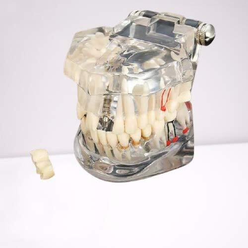 Identical Dental All-In-One Study Model | Includes Dental Implants, Crown & Bridge, Root Canal | Implant-Supported Bridge | Tooth Avulsion | Abfraction, Caries & Periapical Study Feature