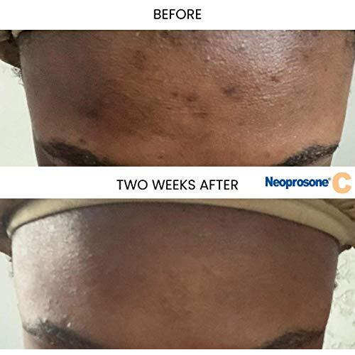Neoprosone, Vitamin C Serum For Face  1 Fl Oz  30Ml  For Dark Circle, Wrinkles & Dark Spots, Hyperpigmentation Serum  With Alpha Arbutin And Castor Oil
