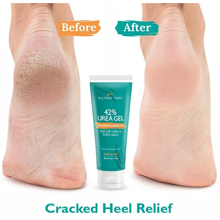 Urea Gel 42 Percent For Feet Maximum Strength Softens Cracked Heel Calluses & Thick Toenails