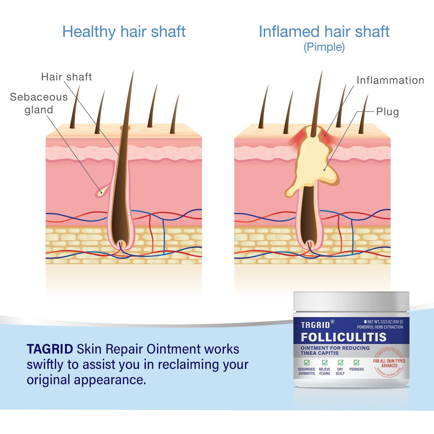 Tagrid Folliculitis, Folliculitis Treatment, Severe Folliculitis Treatment, Lichen, Folliculitis Cream - Safe & Fast - 100G