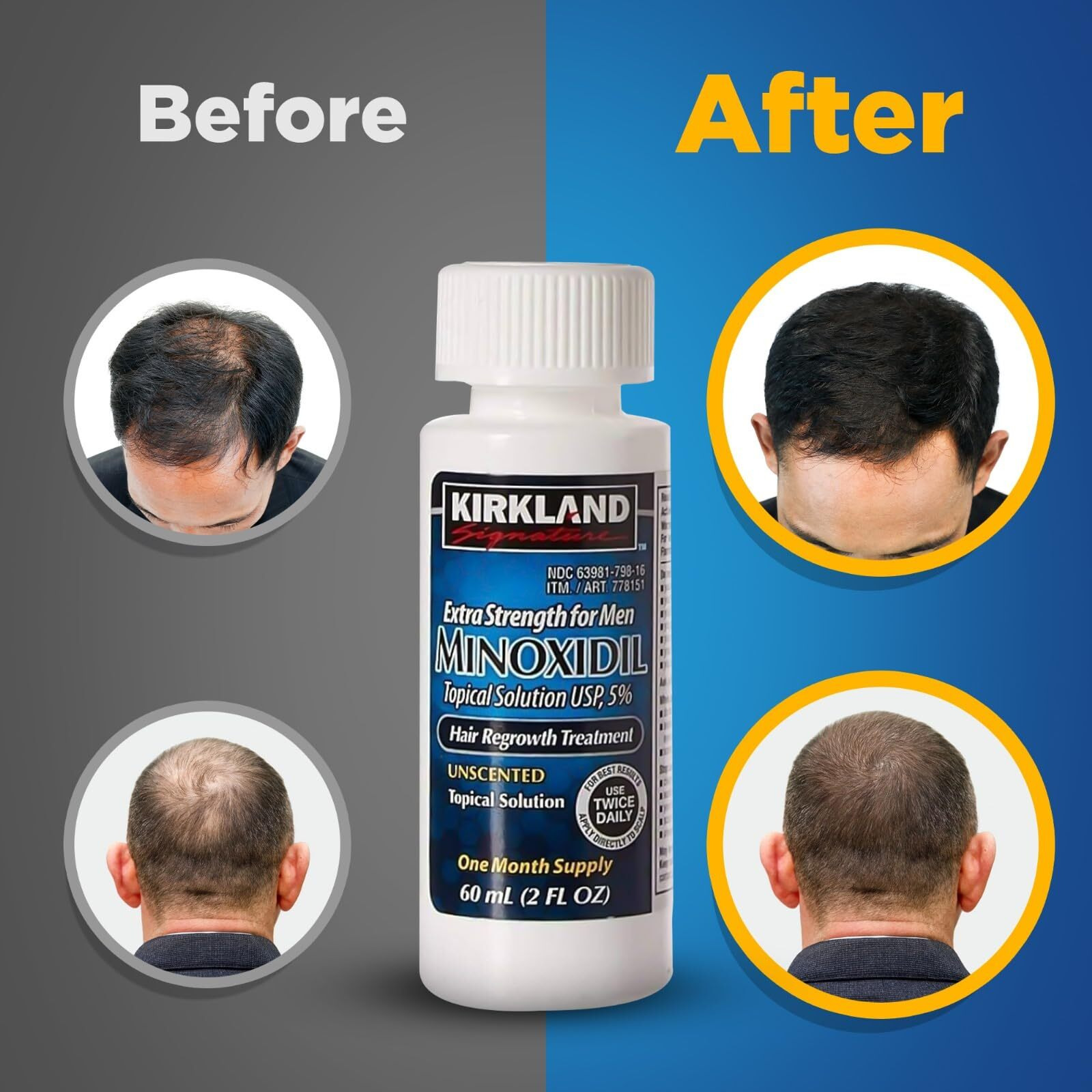 5% Minoxidil Topical Solution For Men - 6 Month Supply (6 X 2 Fl Oz), Hair Regrowth Treatment With Dropper, Cleaning Cloths & Travel Pouch