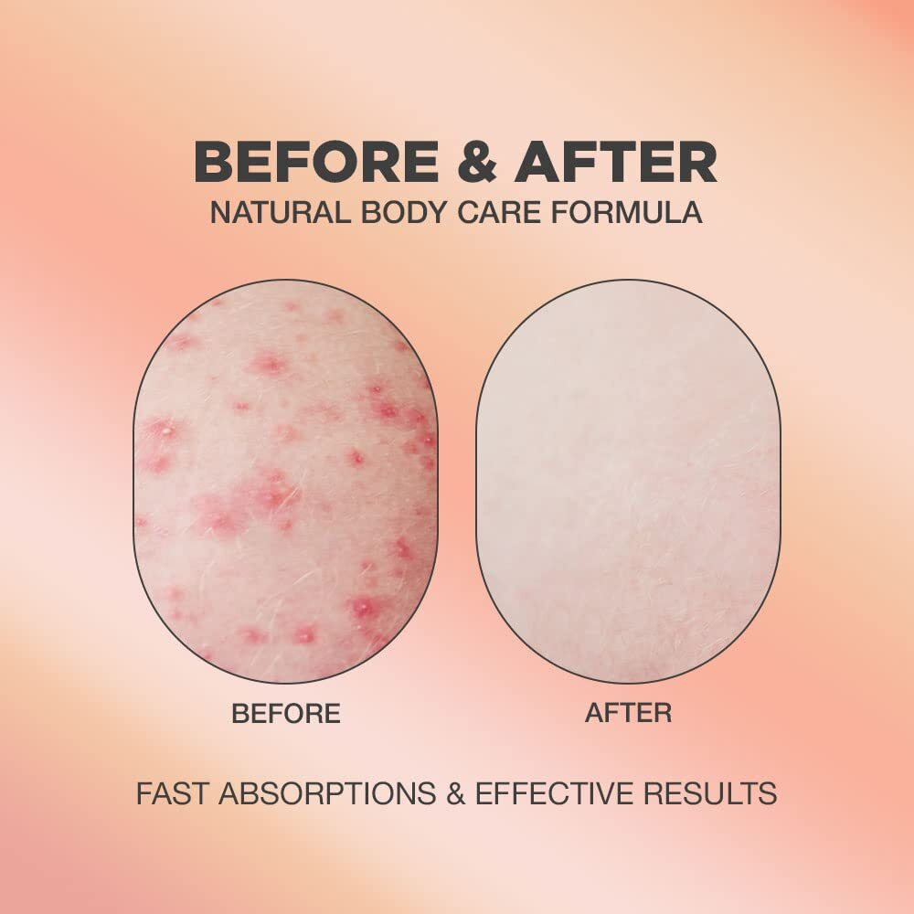Butt Acne & Ingrown Hair Treatment Serum | Aha & Bha Butt Acne And Ingrown Hair Treatment For Bikini Area | Get Rid Of Butt Acne, Ingrown Hair, Back Acne, Strawberry Legs, Kp And Razor Bump | After Waxing Skin Care | Glycolic And Salicylic Acid Body Serum For Ingrown Hair, Butt And Back Acne Treatment Strawberry Legs | Ingrown Hair Cyst Treatment Formula For All Skin Type | Formulated With Centella Asiatica, Green Tea, Rosemary And Natural Ingredients | 1.69 Oz