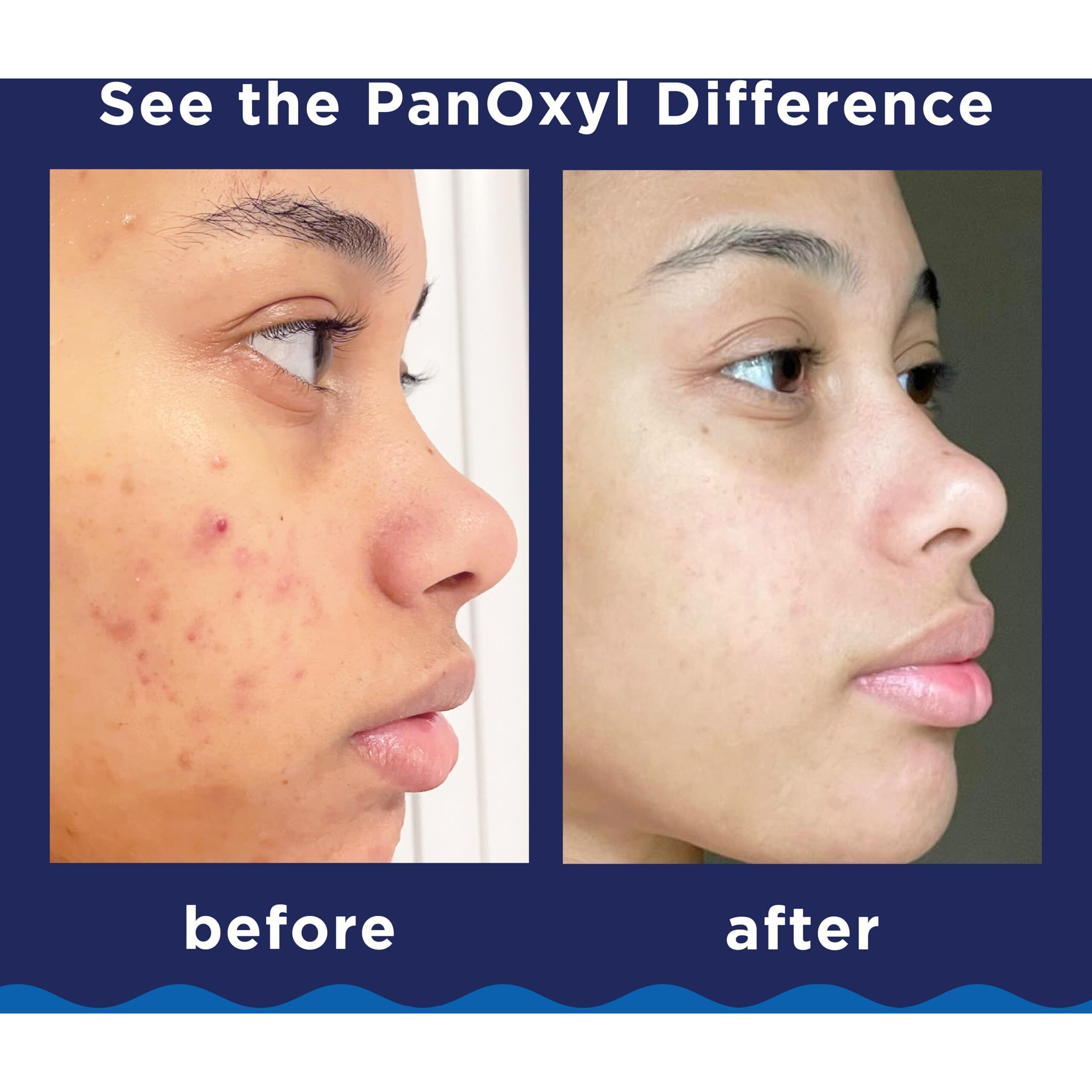 Panoxyl Acne Foaming Wash Benzoyl Peroxide 10% Maximum Strength Antimicrobial, 5.5 Oz