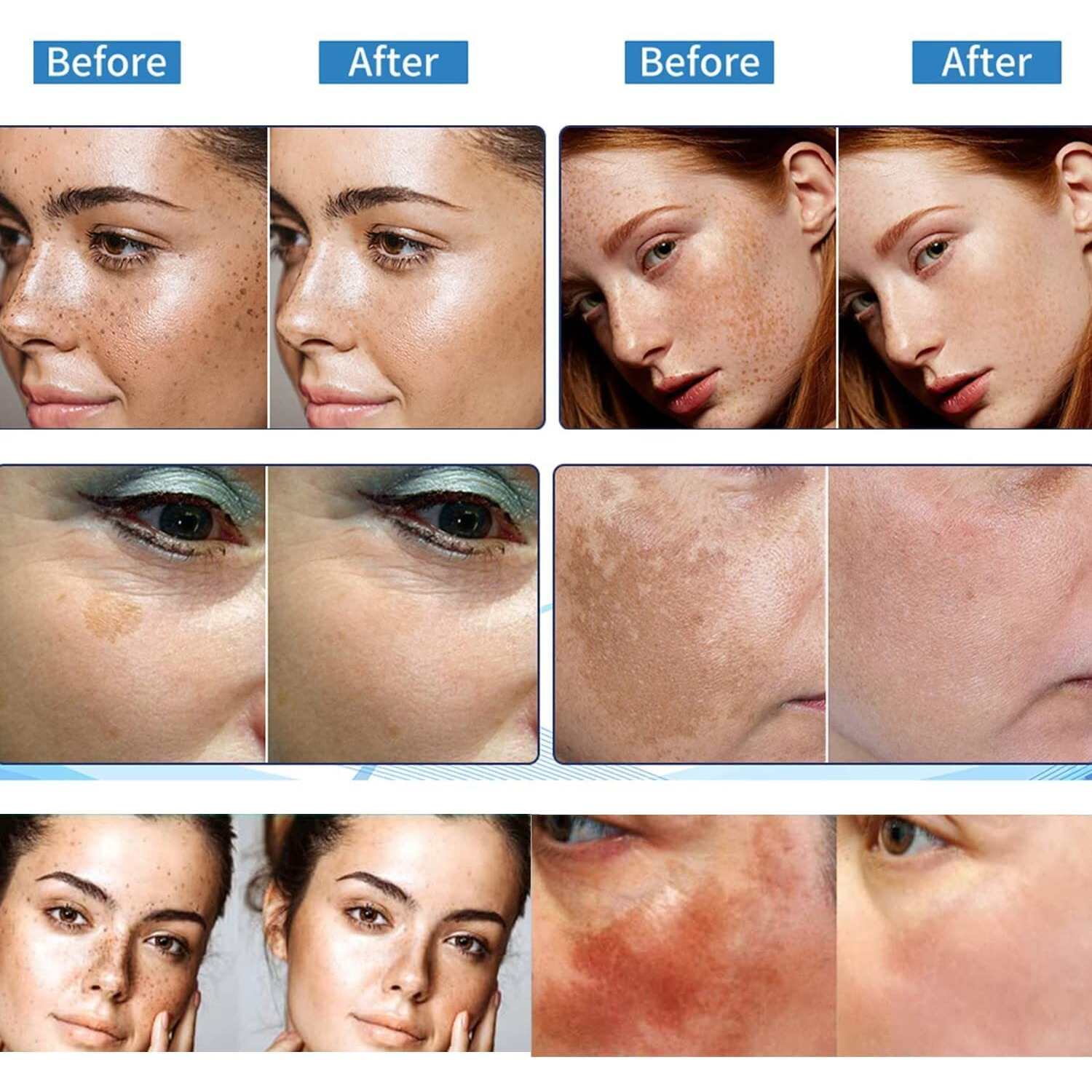 Paradise Emerald Dark Spot Remover For Face, Hyperpigmentation Treatment, Melasma, Freckle, Sun Spots Removal For All Skin Types Dark Spot Corrector For Men And Women