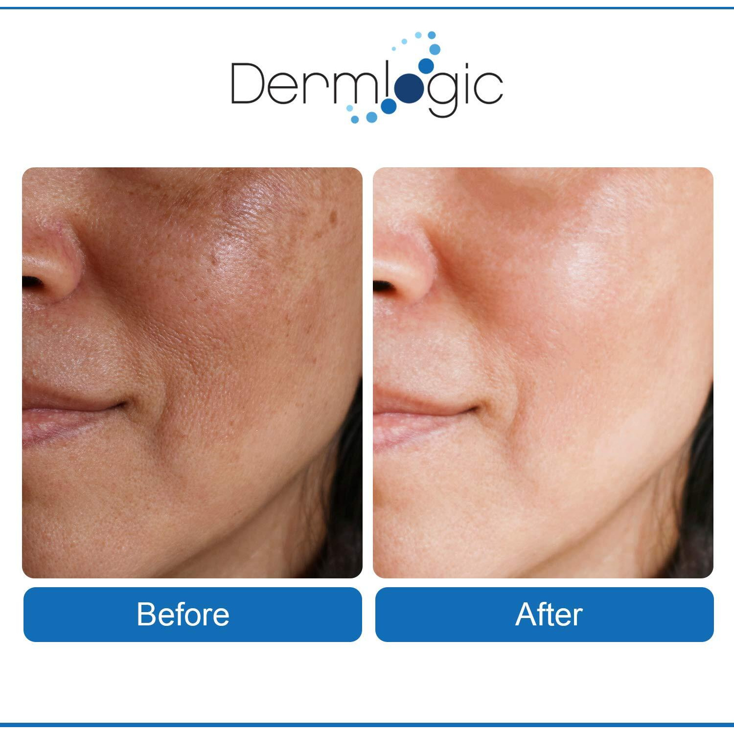 Anti Aging Resurfacing Peel Pads- Triple Action Chemical Peel Pads Combined With Glycolic, Lactic, And Salicylic Acids. Smooths Fine Lines, Wrinkles, Dark Spots, And Imperfections To Enhance The Skin