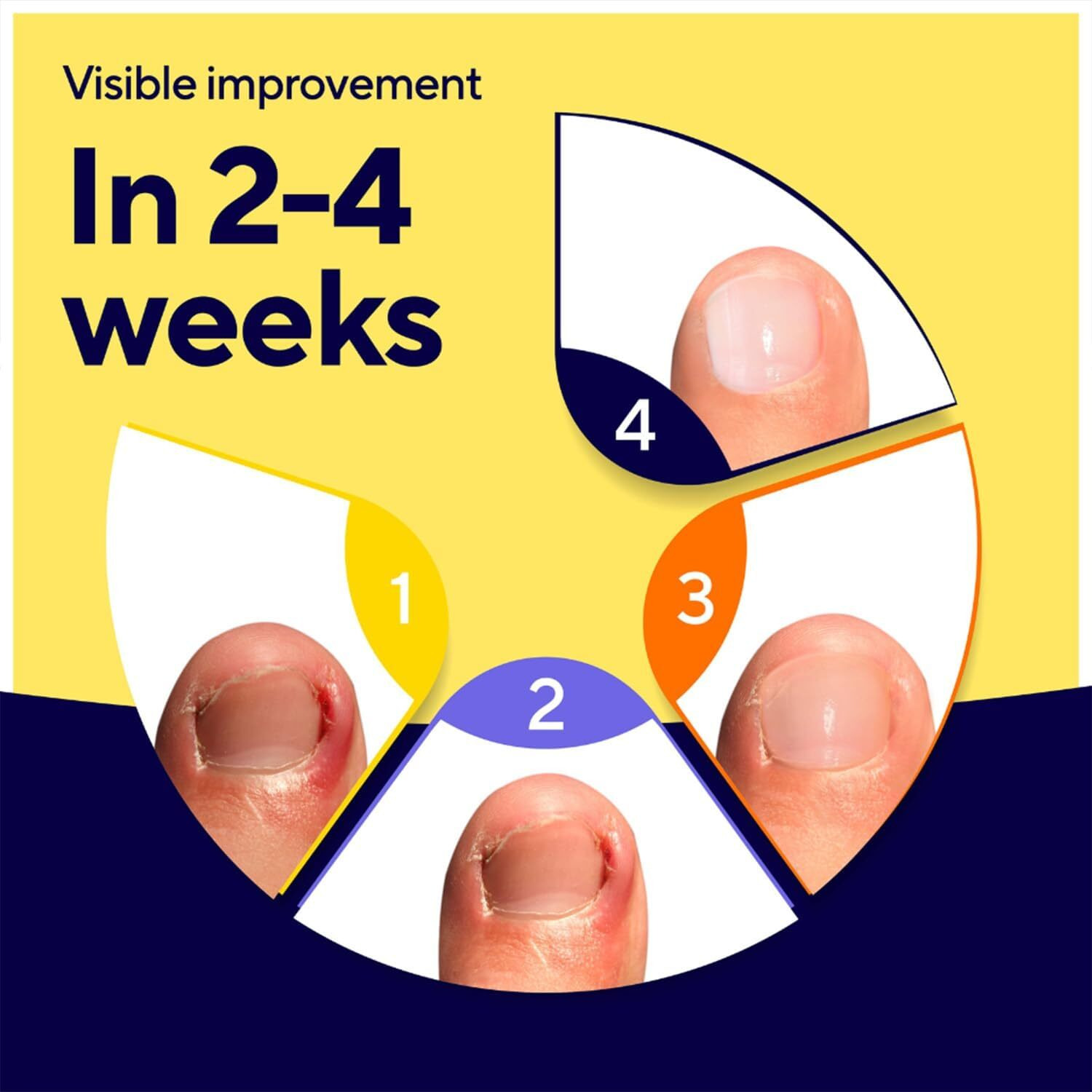 Uriel Upgraded Ingrown Toenail Treatment, Ingrown Toenail Drops Ingrown Nail Treatment Care For Ingrown Toenail Discomfort, Easy To Apply Toenail Softener 11 Ml