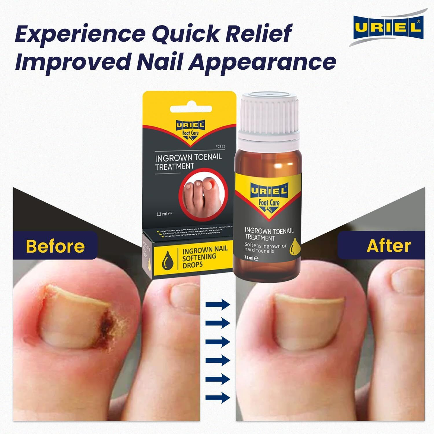 Uriel Upgraded Ingrown Toenail Treatment, Ingrown Toenail Drops Ingrown Nail Treatment Care For Ingrown Toenail Discomfort, Easy To Apply Toenail Softener 11 Ml