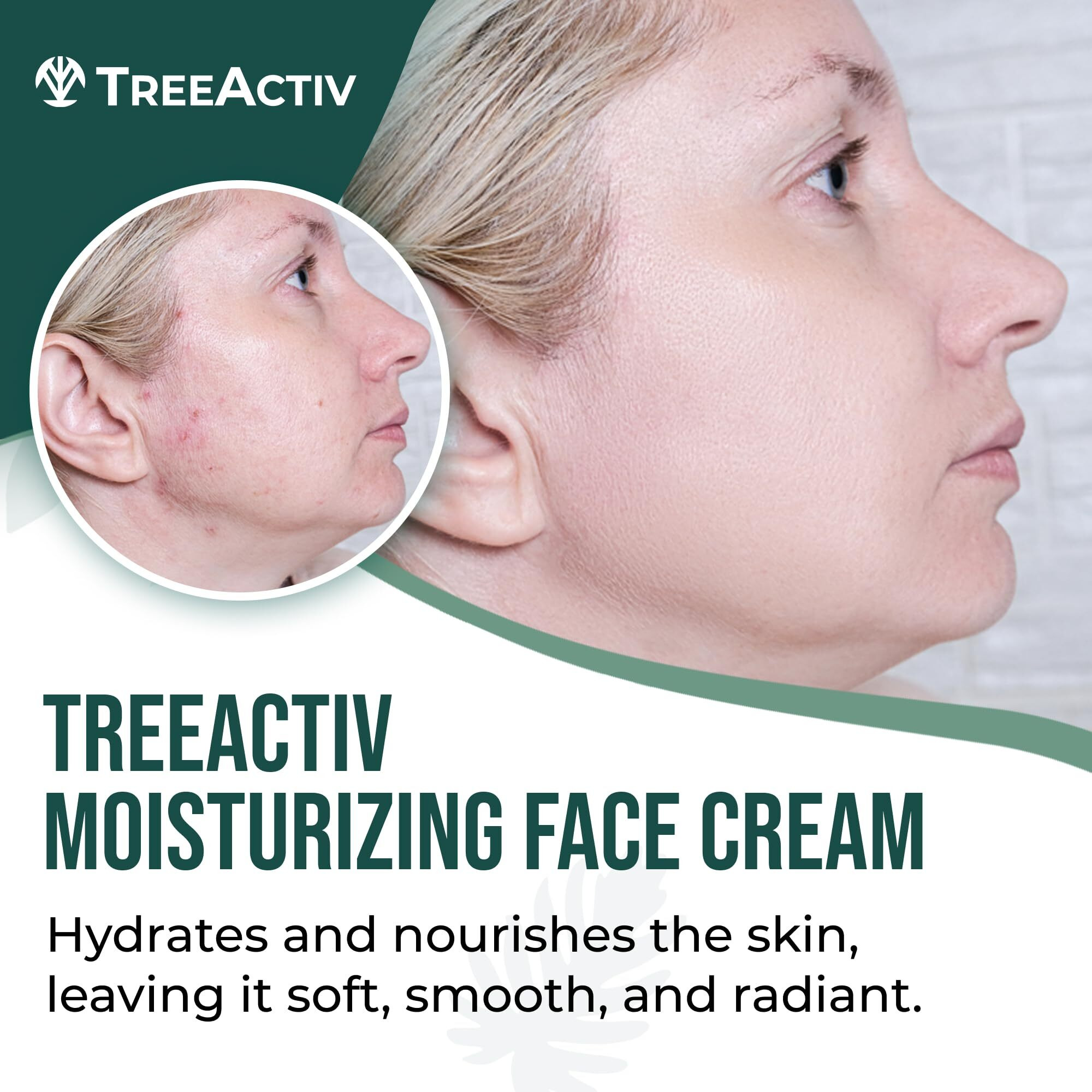 Treeactiv Acne Cream Original Formula, 2 Fl Oz, 2% Salicylic Acid Face Moisturizer For Oily Skin, Skin Care Acne Formula For Cystic Acne Treatment, Hydrating Face Moisturizer For Acne Prone Skin