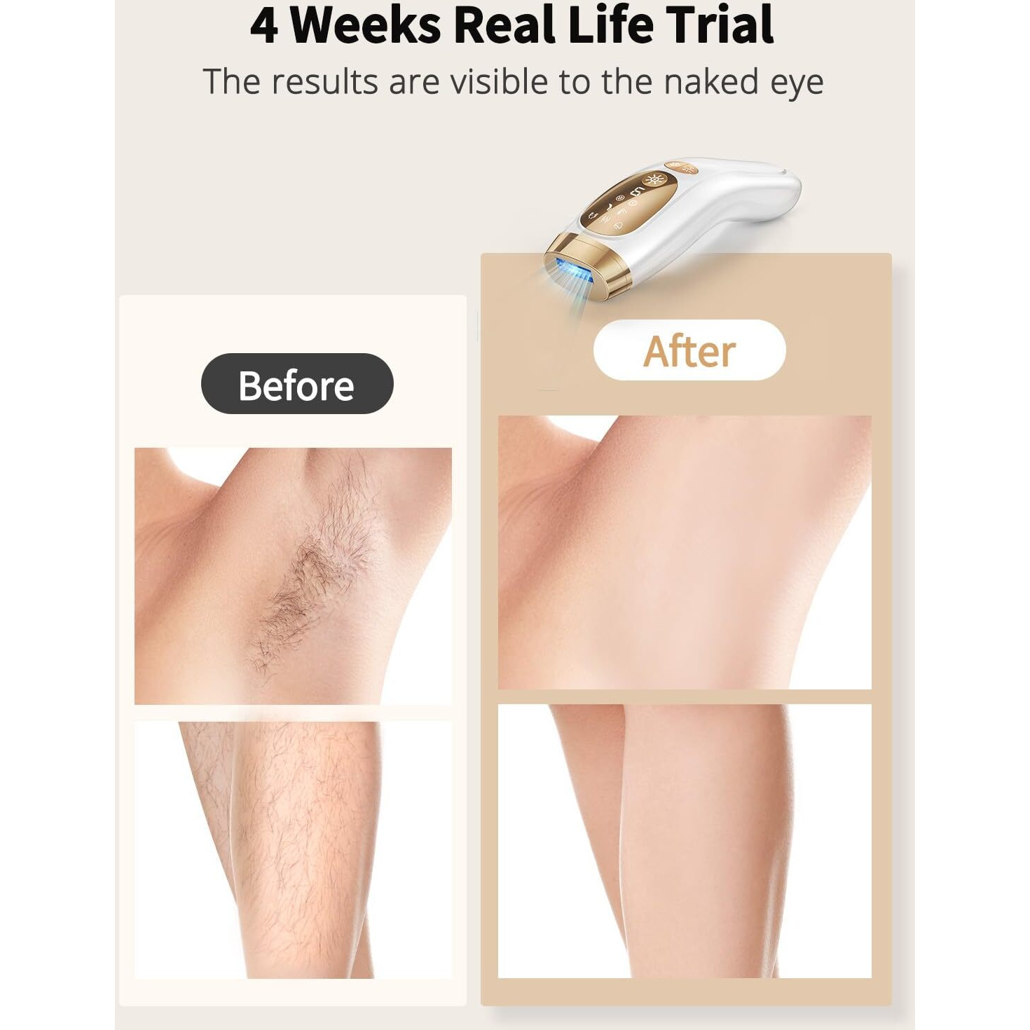 Uenmoon Laser Hair Removal For Women And Men - Ipl Hair Removal With Ice-Cooling System For Painless & Long-Lasting Result, Whole Body Hair Removal
