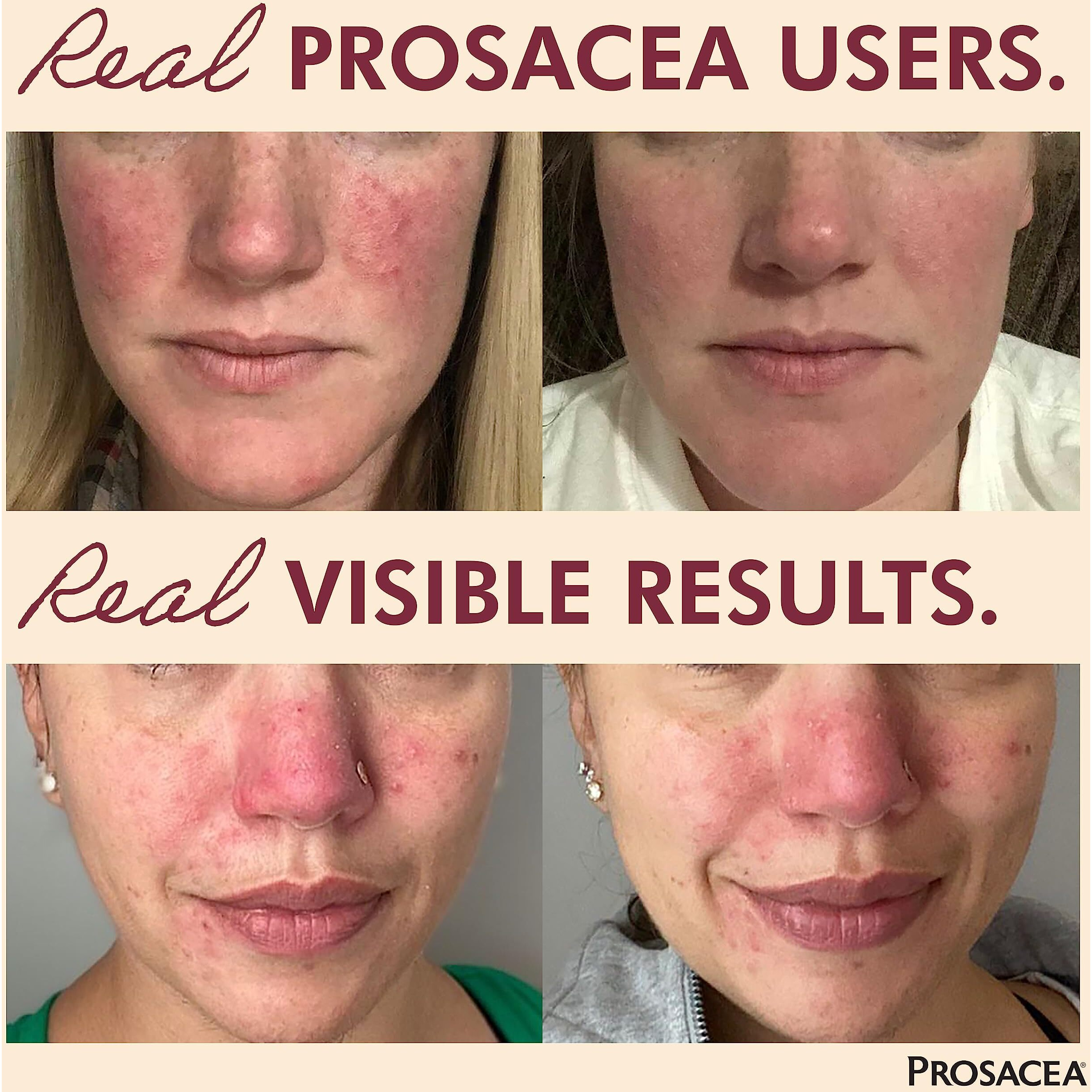 Prosacea - Medicated Rosacea Treatment For Face - Heals Rosacea Symptoms Of Redness, Pimples And Irritation - Fragrance Free - Twin Pack - Two 0.75Oz Tubes (1.5Oz Total)