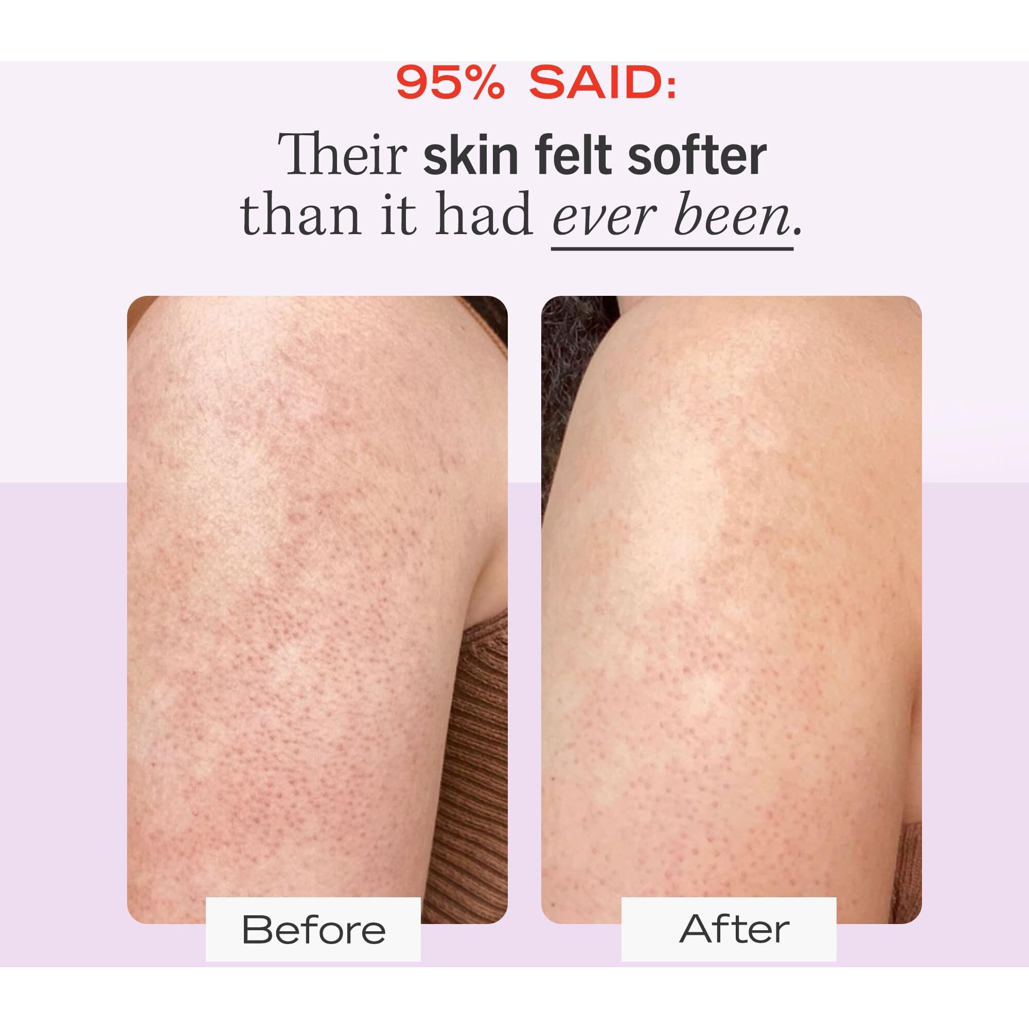 First Aid Beauty - Kp Bump Eraser Body Scrub With 10% Aha, Keratosis Pilaris Skin Exfoliater With Glycolic And Lactic Acids, Helps Reduce Chicken Skin Bumps, Safe For Sensitive Skin, 2 Oz