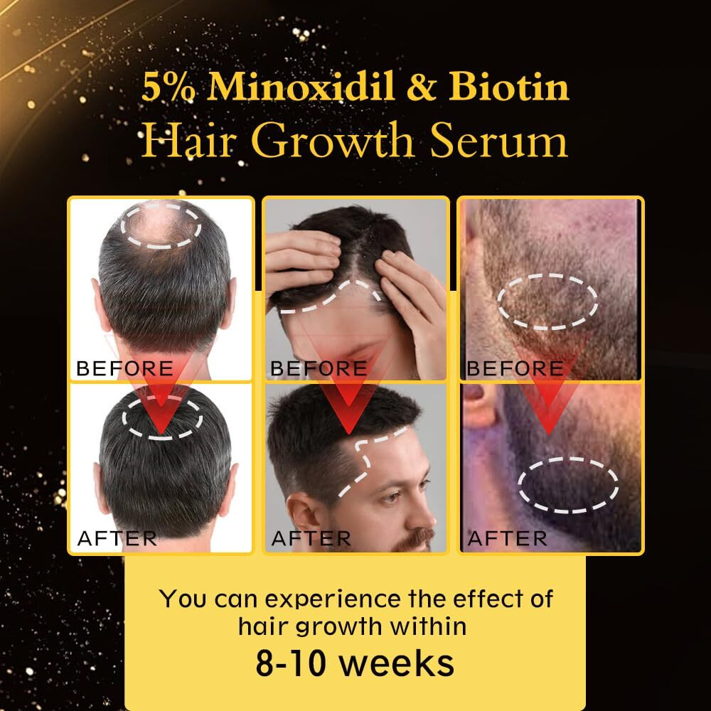 5% Minoxidil Hair Regrowth Oil For Men And Women - Extra Strength Topical Serum For Hair Loss, Promotes Thicker, Healthier Hair And Beard Growth Kit, 2.11 Fl.Oz